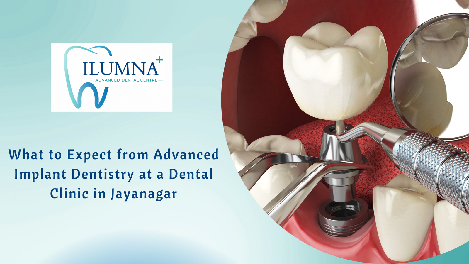 Advanced Implant Dentistry treatment at a dental clinic in Jayanagar, Bangalore, featuring a dental implant with crown and surrounding teeth.