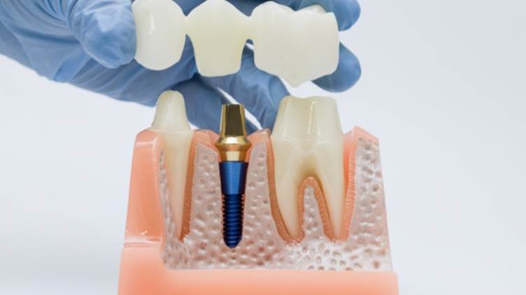 Dental implant procedure showing an implant placed in the jawbone to replace a missing tooth