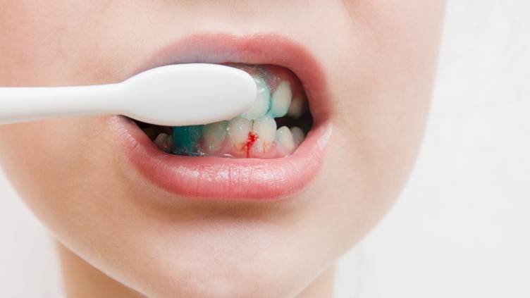Child brushing teeth with visible gum bleeding at a dental clinic in Jayanagar, highlighting bleeding gums and oral health care