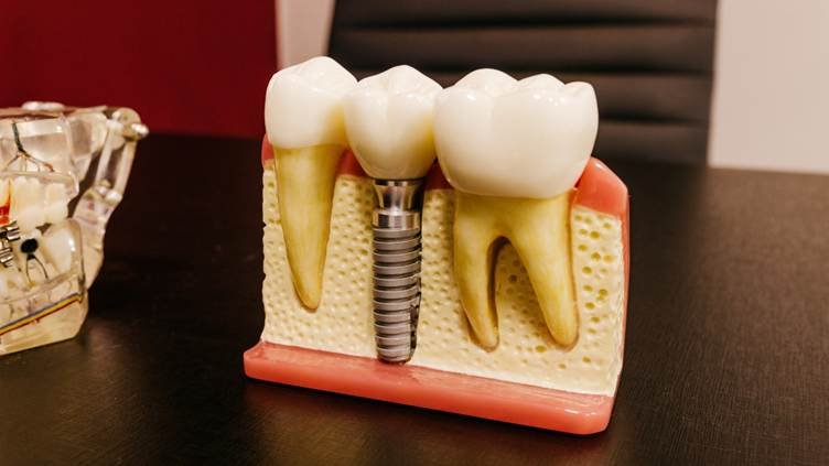 Dental implant model showing a titanium implant, dental crown, surrounding teeth, gums, and jawbone at a dental clinic in Jayanagar.