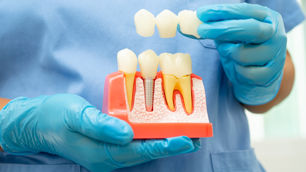 Dentist in Jayanagar demonstrating dental implant and crown placement using a tooth model`