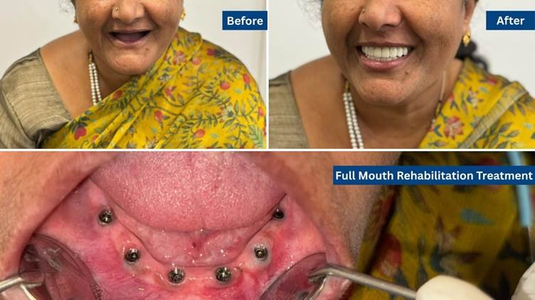 Dentist in Jayanagar full mouth rehabilitation before and after dental treatment