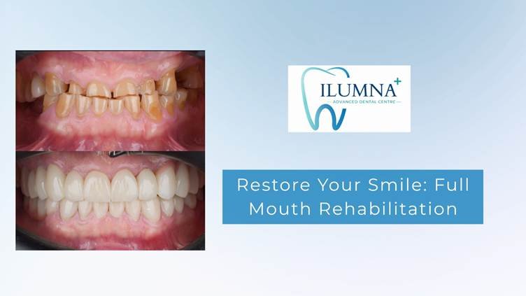 Dentist in Jayanagar showing full mouth rehabilitation before and after results